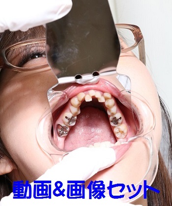 弥生ちゃんは元歯科助手なのに立派な銀歯が何本も　★★動画＆画像セット★★
