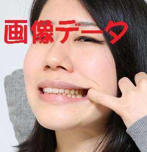 オクチおっきい美咲ちゃんの歯　画像データ　おや？虫歯？