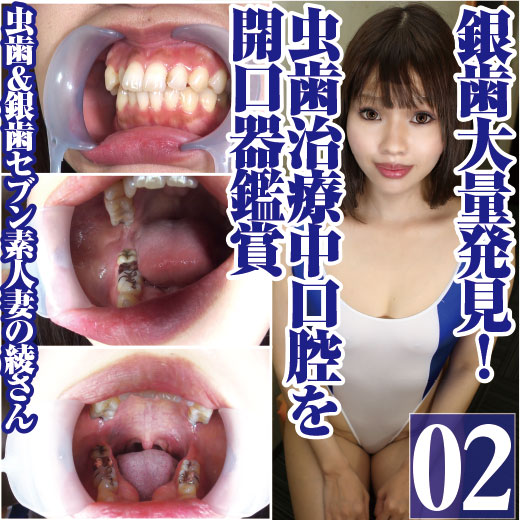 虫歯&銀歯セブン妻の綾の銀歯大量発見!虫歯治療中口腔を開口器鑑賞 虫歯&銀歯セブン妻の綾の銀歯大量発見!虫歯治療中口腔を開口器鑑賞