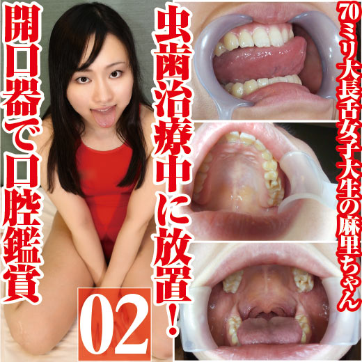大長舌女子大生の麻里ちゃんの虫歯治療中に放置!開口器で口腔鑑賞 大長舌女子大生の麻里ちゃんの虫歯治療中に放置!開口器で口腔鑑賞