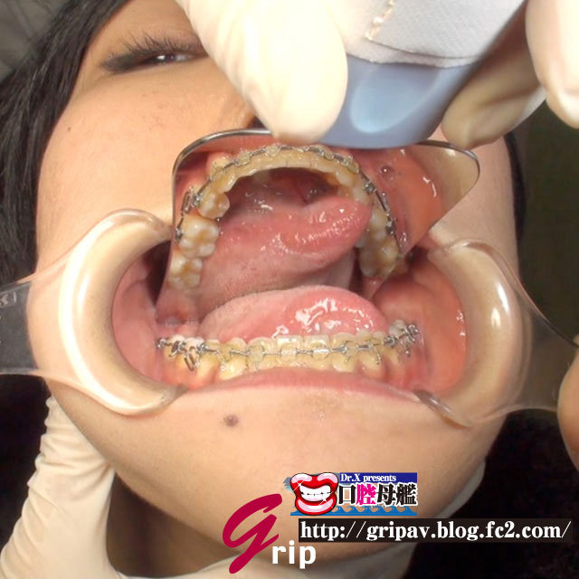 歯列矯正中の女～開口器＆大型ミラーで観察
