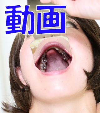 有紀ちゃん銀歯だらけ! 動画 有紀ちゃん銀歯だらけ! 動画