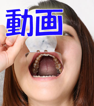 ひかりちゃんの歯　銀歯と虫歯　動画