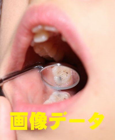美奈子の歯　画像データ
