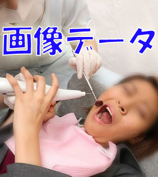 がっつりクラウン娘　亜理紗ちゃんの虫歯をスケーラーで　画像データ