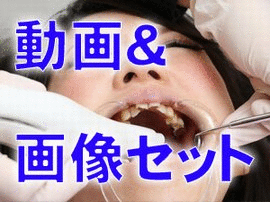すみれちゃんの銀歯と欠損2　★★動画＆画像セット★★「歯医者行ったら全部銀歯に・・・」
