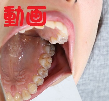 虫歯の本数にがっくし千秋　元歯科助手ｗｗ　　動画